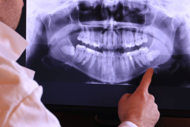 Best Knocked-Out Tooth (Avulsed Tooth) Treatment in Hudson, PA